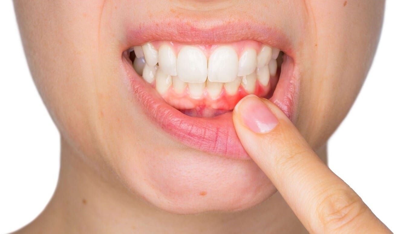 Gum Disease Therapy Near me | Gum Disease Treatment At Bloor and Dufferin In Toronto